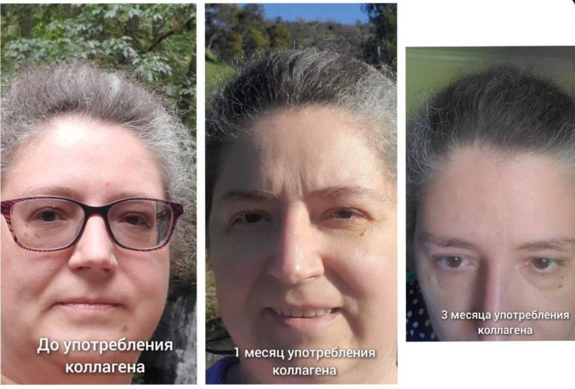 Progress: appearance of hair alongside taking collagen
